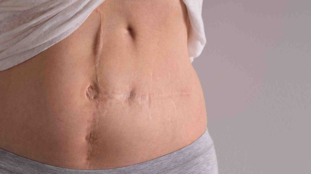 Close-up of abdominal scar tissue, illustrating physical damage that can result from heroin use and its associated risks.